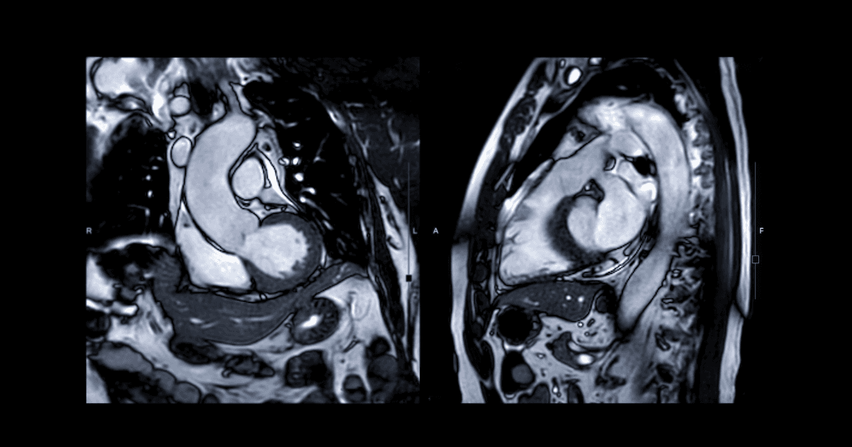 Cardiac MRI Inference from ECG